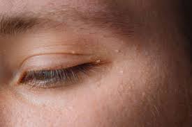 Image result for milium cyst on eyelid
