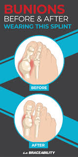 Before And After Bunion Splinting Surprised By These Results While A Bunionectomy Bunion Removal Surgery Is Th Get Rid Of Bunions Bunion Vicks Vaporub Uses