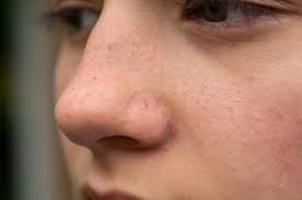 Image result for demodex rosacea