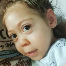 Hello everyone. I would like to introduce myself. My name is Dejana and I  am the mother of Natasa, who is 3 years old. Our diagnosis is  holoprosencephaly. We recently learned that