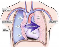 Image result for Open Pneumothorax