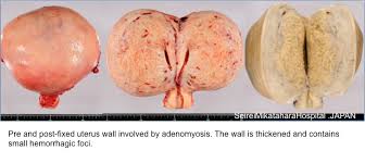 Adenomyosis presents with very similar symptoms as endometriosis. Pathology Outlines Adenomyosis Adenomyoma