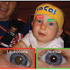 Use the menu to see other pages.many symptoms of neuroblastoma are caused by pressure from the tumor or bone pain if the cancer has spread to the bones. 1
