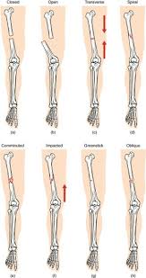 Blood on the floor and four more. Sport Injury Classification Physiopedia