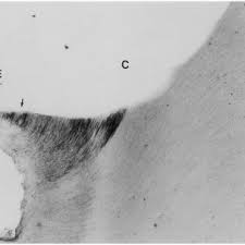 The use of caries detector dye is often frowned upon by the masses. Pdf Caries Detector Dyes An In Vitro Assessment Of Some New Compounds