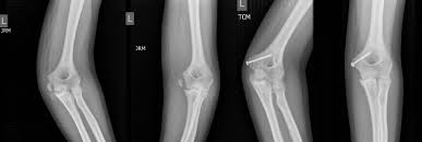 Traditional management by cast immobilization increasingly is being replaced with early fixation and mobilization. Medial Epicondyle Fractures To Fix Or Not To Fix Sciencedirect