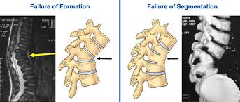 Image result for kyphosis