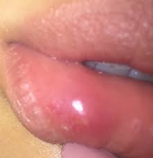 Weisse Blasschen In Der Innenseite Der Lippe Was Ist Das Schmerzen Herpes Aphten