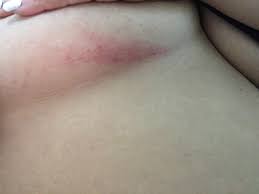 Image result for heat rash under breasts