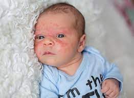 Powders should be avoided, unless they are recommended by your baby's doctor. Baby Eczema Symptoms Causes And Treatments