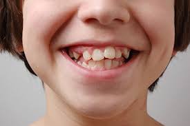 How to get vampire teeth permanently. Impacted Canines Orthodontist Cincinnati West Chester Oh Nelson R Diers Dds Msd