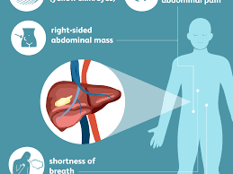 Anyone with consistent or severe pain in the right side of. Liver Cancer Signs Symptoms And Complications