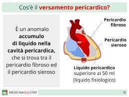 Lupus & pericardite mesotelioma & pericardite. Versamento Pericardico Sintomi Cause Diagnosi E Cura