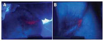 Image result for Erythrasma