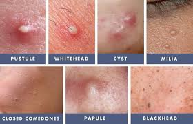 How to treat closed comedones. How To Treat Whiteheads On The Face So Your Skin Can Be Clear And Bump Free Skin Facts Types Of Acne Acne Skin