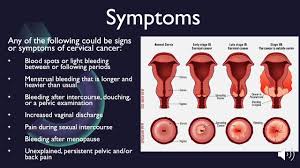 The menstrual irregularities could have a prolonged bleeding, intermittent menstrual bleeding, heavy bleeding. Cervical Cancer Infomercial Youtube