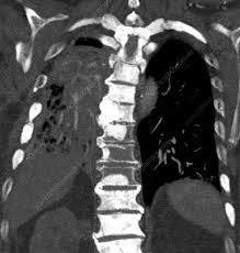 For breast cancer, these can include computed tomography (ct or cat) scans and positron emission tomography (pet) scans, as well as bone scans to find out if the cancer has spread to the bone. Metastatic Breast Cancer Ct Scan Stock Image C039 3602 Science Photo Library