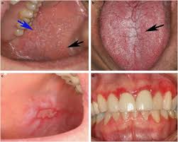 Image result for lichen planus on tongue)