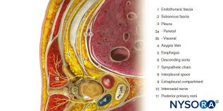 Image result for Intrapleural Anesthesia