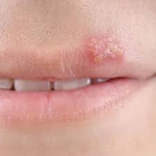 They're typically small, only about 1 to 2 millimeters in diameter, although some can become larger than that. 13 Face Bumps You Get Under Your Skin And How To Get Rid Of Them
