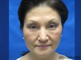 Fat Transfer Gallery