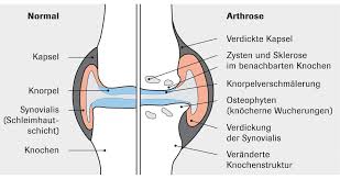 Arthrose Rheumaliga Schweiz