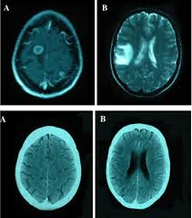 20% of all cases of pediatric cancer. Ct Scan Of A Brain Tumor After Using Frankincense Frankincense Essential Oil Frankincense Essential Oil Skin Frankincense Essential Oil Uses