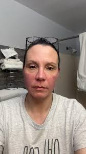 Using Original Skin Repair for Wind Burn in Ashland, WI