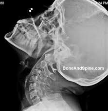 This procedure may be used to diagnose back or neck pain, fractures or broken bones, arthritis, degeneration of the disks, tumors, or other problems. Flexion Extension Xrays Of Cervical Spine Bone And Spine