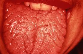 Image result for Fissured tongue