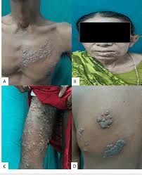 Image result for herpes zoster