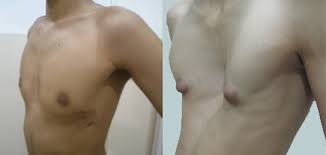 Image result for Pectus Excavatum