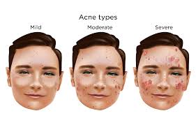 Image result for acne face