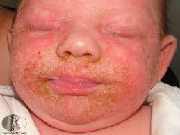 Image result for white scabs on the head in children