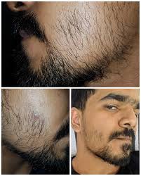 The best results usually come from users who've applied minoxidil for at least 1 year. What Type Of Minoxidil Is Best For Beard Growth