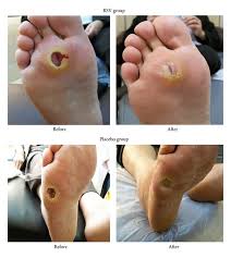 Sepanjang 6 bulan cuci luka, saya ada periksa paras gulanya, elok sahaja. Figure 2 Resveratrol Promotes Foot Ulcer Size Reduction In Type 2 Diabetes Patients