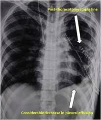 A pleural surface permeability) — exudative effusion. Testicular Mixed Germ Cell Tumour With Isolated Skip Metastasis To Unilateral Pleura First Case Reported In The Literature Sciencedirect