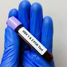 Image result for Herpes Simplex Virus Testing