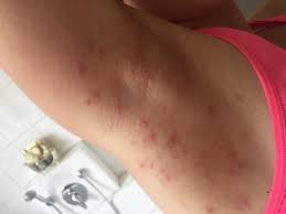 Jetzt habe ich diese 3 vllt wieder ca 3 tage und die tun schon bisschen weh. Ausschlag Unter Den Armen Woher Konnten Die Pickel Kommen