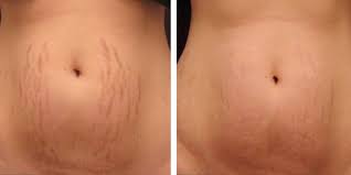 Bio Oil White Stretch Marks Before And After Microneedling For Stretch Marks Microneedling Stretch Marks Stretch Mark Treatment Derma Roller Stretch Marks