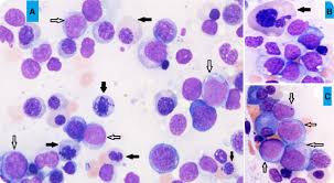 Mayo Clinic Researchers Develop Genetics Based Prognostic Tool For Myelodysplastic Syndrome