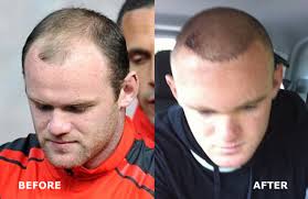 Wayne Rooney Hair Transplant Before And After Hairline Hair Transplant Wayne Rooney Hair Transplant Hair Today Gone Tomorrow