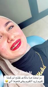 نتائج تقويم الأسنان خلال 3 أشهر فقط