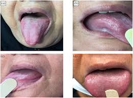 Image result for lichen planus on tongue)