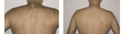 The duration of the hair removal sessions varies as it depends on the surface to be treated. Best Laser Hair Removal In Montreal Epilation Laser Lumiere Pulsee A Montreal Quebec Canada Lumilaser