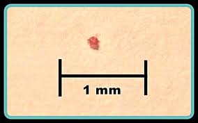 Bird Mites In Hair Bird Mite Characteristics Mites Insect Species Bird