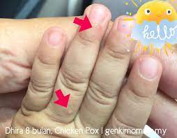 Ketahui juga risiko komplikasi cacar penyakit dengan istilah chicken pox atau varicella simplex ini penyebarannya bisa sangat cepat sakit kepala merupakan tanda awal cacar air juga dan cukup banyak dialami oleh penderita cacar air. Bayi 8 Bulan Chicken Pox Genkimomma My