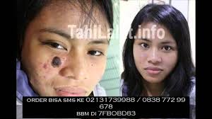 Kemudian, beruskan sedikit dan bilas. Cara Menghilangkan Tahi Lalat Secara Permanen By Tahi Lalat