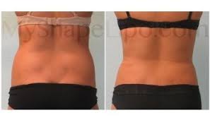 Love Handles And Hips 2 Weeks Smart Lipo Brazilian Buttlift Lipo
