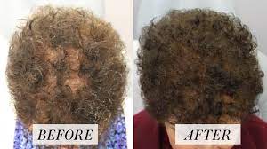 Prp treatments can enhance hair restoration and other cosmetic plastic surgery procedures. Platelet Rich Plasma Treatment For Hair Loss Here S What To Know Allure